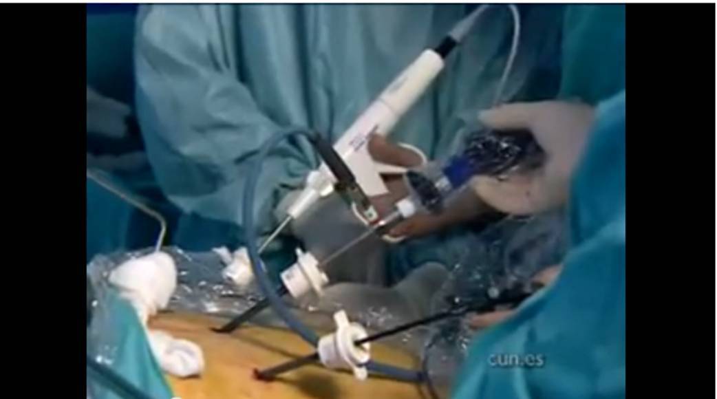 Intervención de pancreatectomía central laparoscópica. CUN