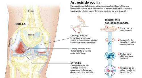 Infográfico artrosis de rodilla Imagen preview del infográfico sobre la artrosis de rodilla y su tratamient con células madre