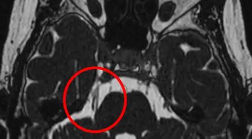 Neuralgia del trigémino. RMN. Clínica Universidad de Navarra