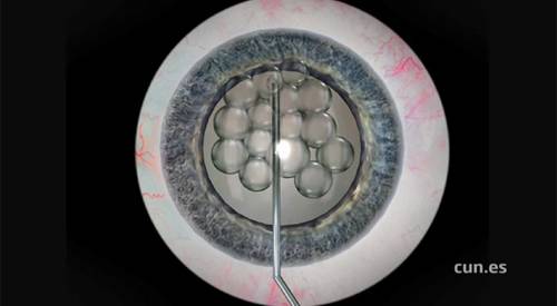 Ojo virtual obtenido por el simulador de cirugía de los ojos Imagen de un ojo virtual obtenido por el simulador de cirugía de los ojos que existe en el Departamento de Oftalmología para la realización de los cursos de simulación oftalmológica.