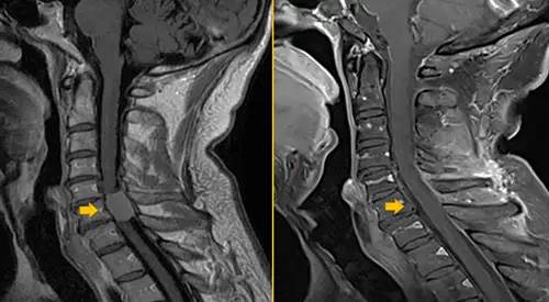Resonancia magnética de un tumor medular. Clínica Universidad de Navarra Imagen de una resonancia magnética en donde se diagnostica un tumore medular.