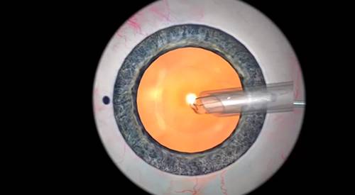 Simulador EyeSI en una cirugía lente intraocular Imagen del simulador EyeSi durante la realización de una cirugía de colocación de una lente intraocular