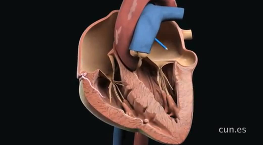 Corazón. CUN