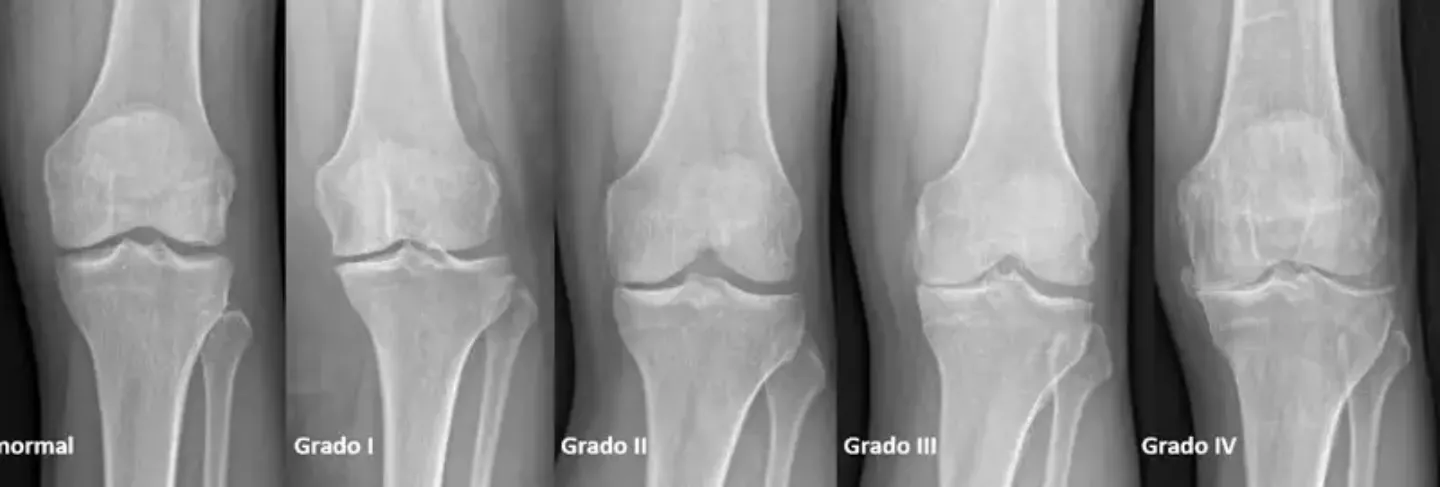 Artrosis de Rodilla