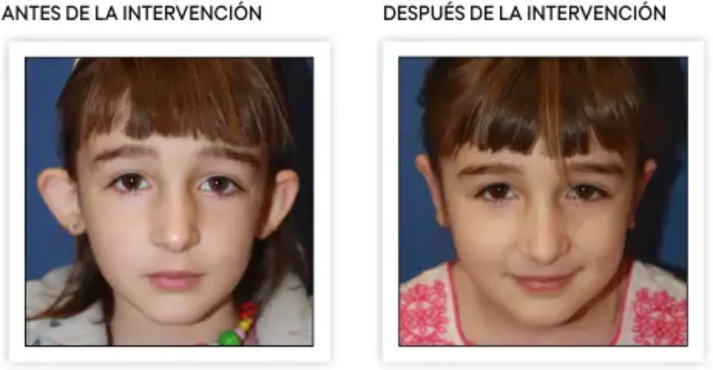 resultados_otoplastia <p>Resultados tras la intervención de otoplastia, orejas en soplillo </p>