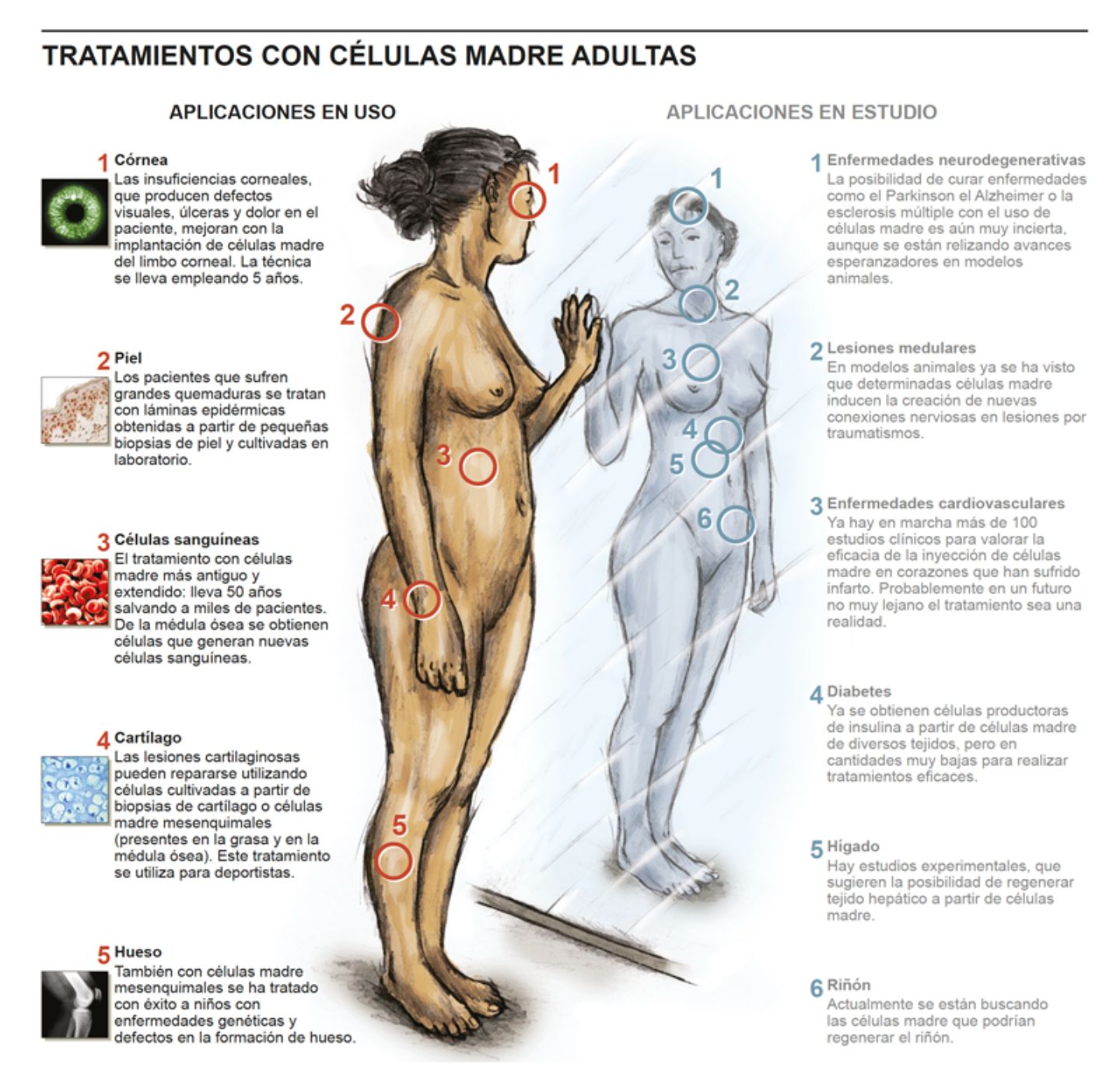 menor Predecir célula Infográfico. Indicaciones del tratamiento con células madre. Clínica  Universidad de Navarra