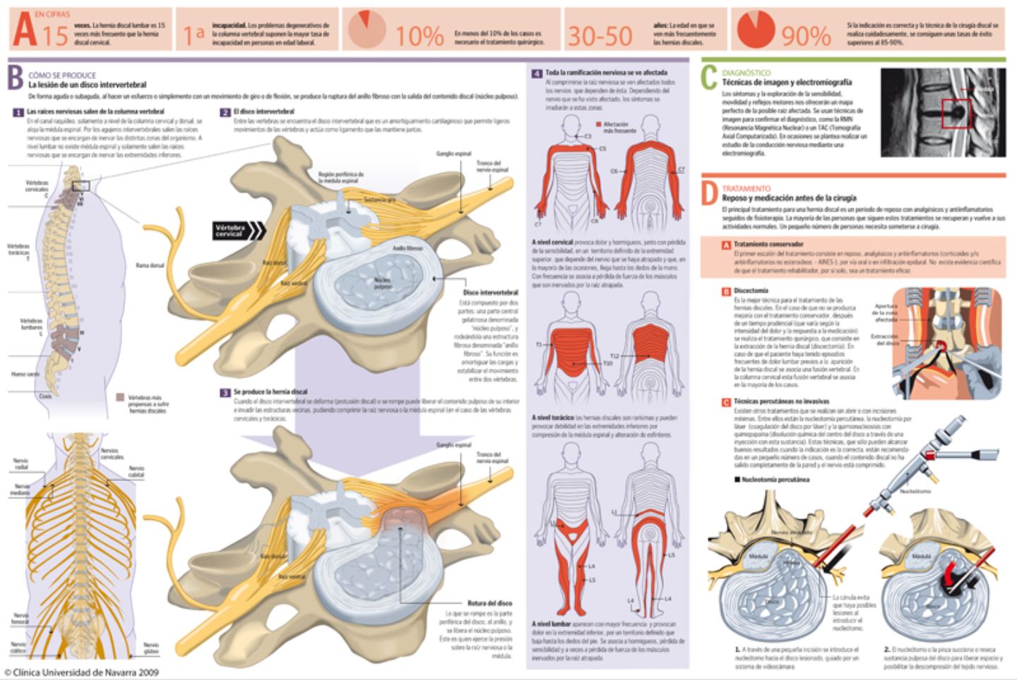 Infográfico. Hernia discal. Clínica Universidad de Navarra