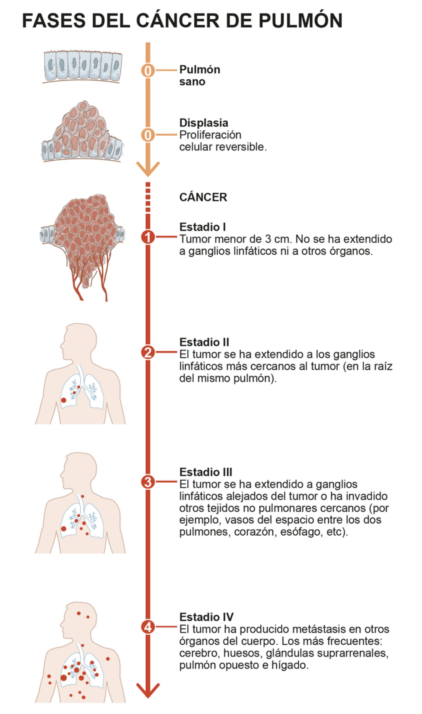 diagrama que muestra diferentes estadios del cáncer de pulmón imagen ...