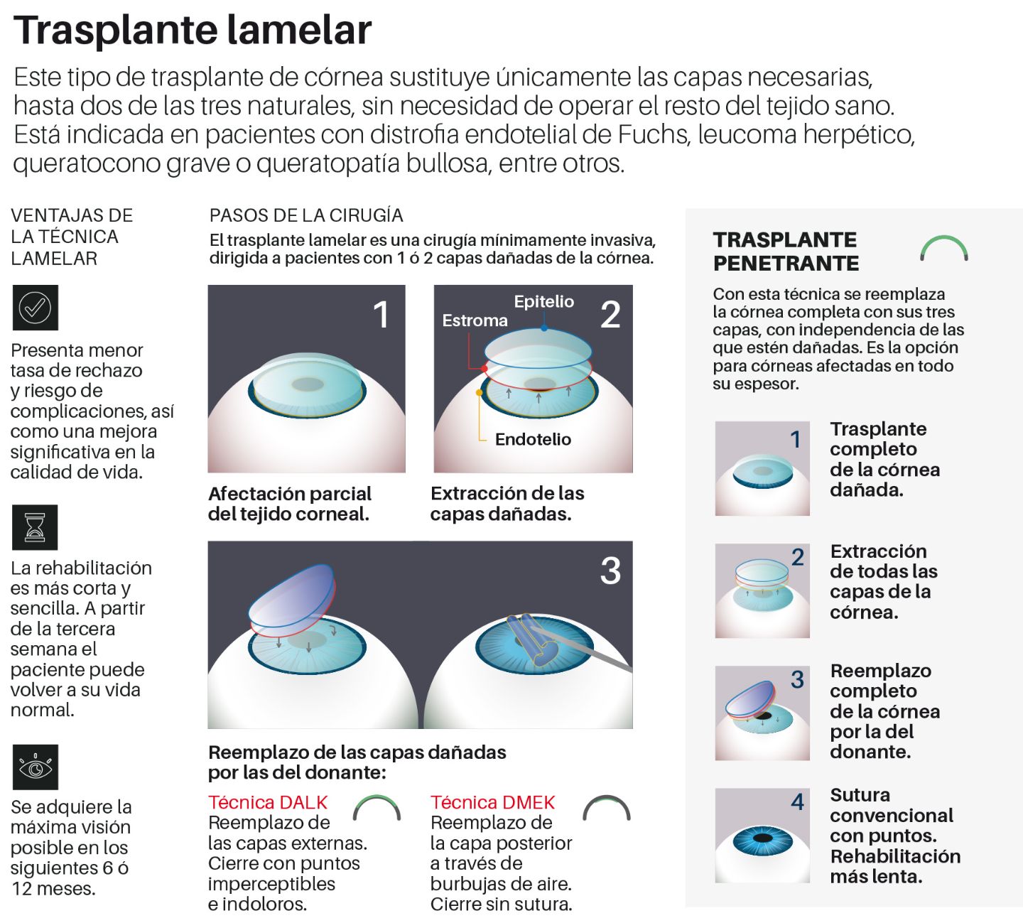 Infografía del trasplante lamelar en la Clínica Universidad de Navarra.