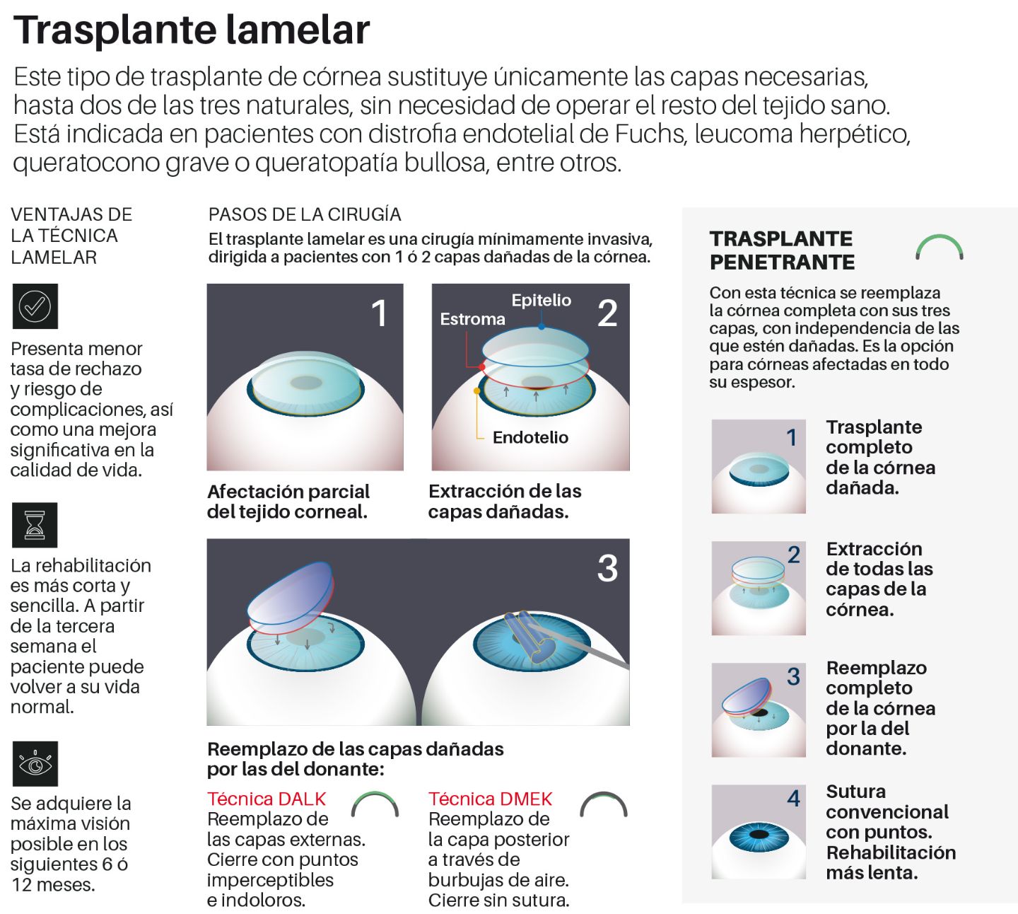 Infografía trasplante lamelar, Clínica Universidad de Navarra Infografía del trasplante lamelar en la Clínica Universidad de Navarra.