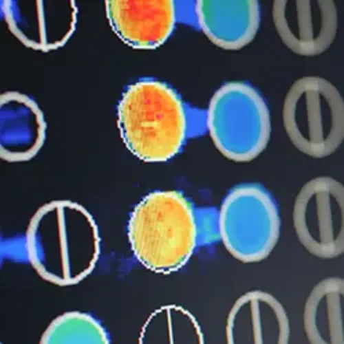 diagnostico-microarrays Técnica de diagnóstico por microarrays. Alergología. Clínica Universidad de Navarra