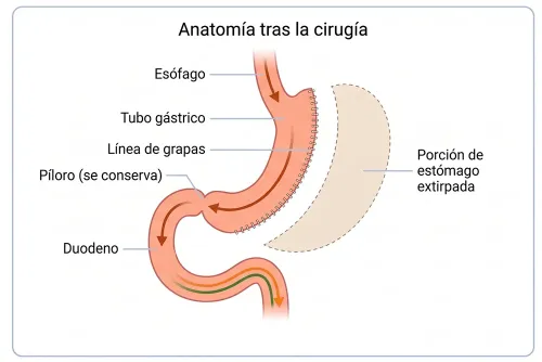Técnica de gastrectomía tubular laparoscópica para el tratamiento de la obesidad.