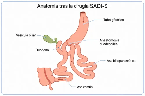 Técnica de SADI-S (bypass duodeno-ileal de una anastomosis con gastrectomía vertical) para el tratamiento de la obesidad.