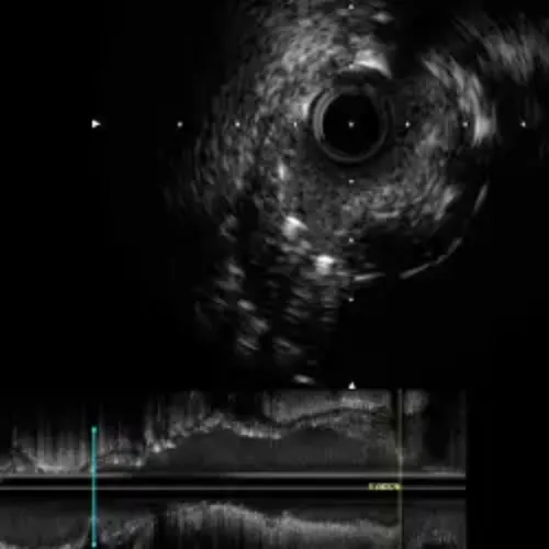img-destacado-ultrasonido-coronario-ivus
