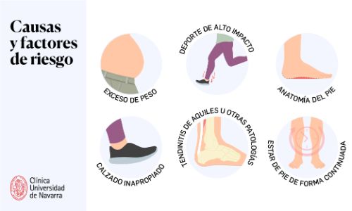 Fascitis plantar. Infografía. Clínica Universidad de Navarra