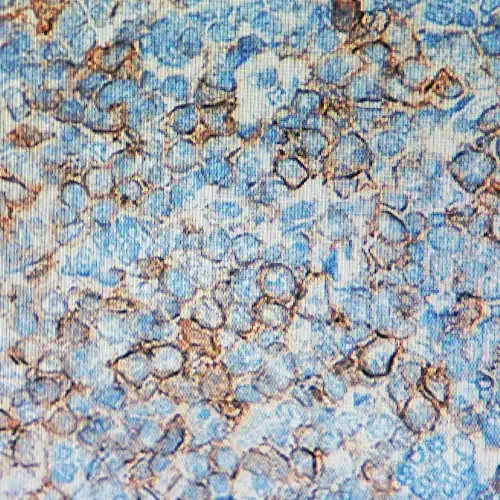 img-anatomia-patologica-sarcoma-ewing