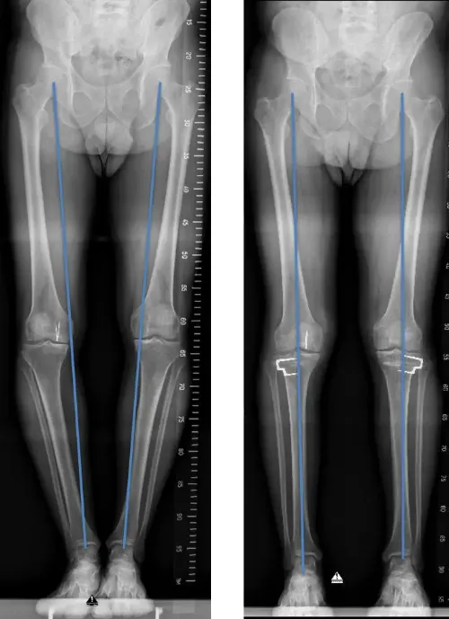 img-osteotomia-correctora
