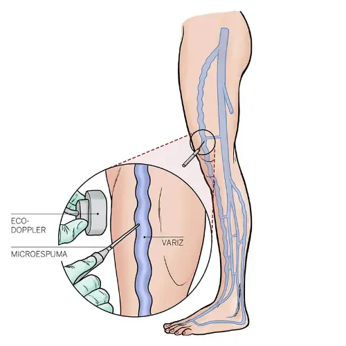 img-destacado-microespuma-varices