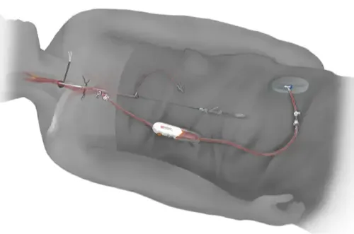 procedimiento-revascularizacion-transcarotidea