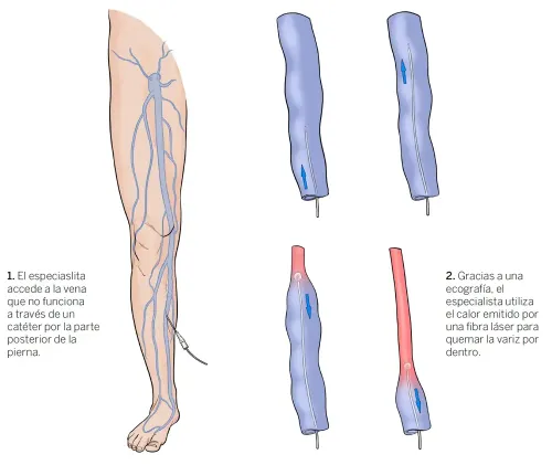 termoablacion-varices