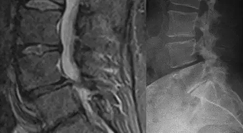 espondilolistesis