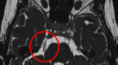 neuralgia-trigemino-rmn