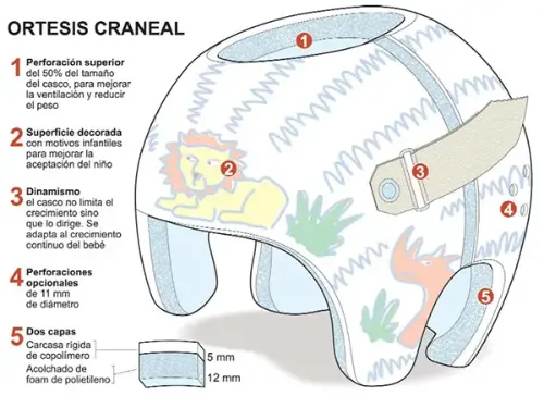 ortesis-craneal <p>La ortesis craneal es un casco especial de remodelado del cráneo, fabricado a medida, para corregir las deformidades en la cabeza de los recién nacidos.</p>