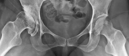 img-radiografia-caderas-nino