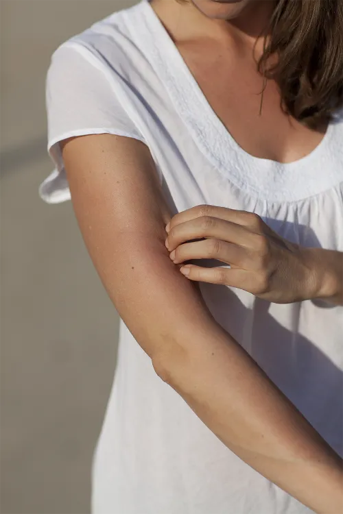 destacado-alergia-sol Imagen de una mujer con alergia al sol.