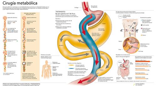 2013-cirugia-metabolica-min <p>Imagen preview del infográfico sobre cirugía metabólica</p>