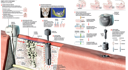 2012_img_preview_infografico_implantes_dentales <p>Image preview del infográfico sobre implantes dentales </p>