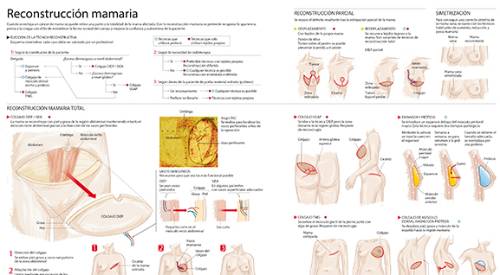 2012-reconstruccion-mamaria-min <p>Imagen preview del infográfico sobre reconstrucción mamaria para el cáncer de mama </p>