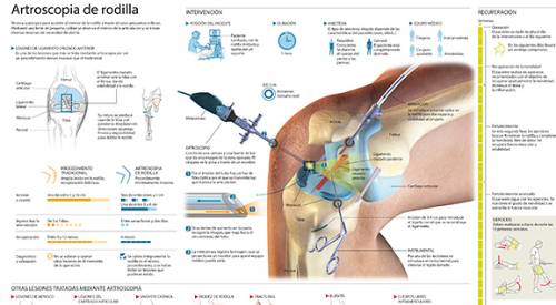 2012-artroscopia-rodilla-min <p>Imagen preview infográfico de artroscopia de rodilla</p>