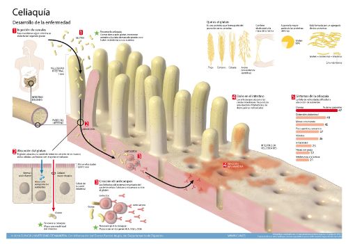 <p>Imagen de previsualizaciÃ³n del infogrÃ¡fico sobre la enfermedad celiaca realizado por la ClÃ­nica Universidad de Navarra</p>