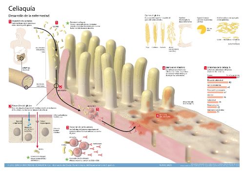 <p>Imagen de la infografía realizada por los especialistas de la Clínica Universidad de Navarra sobre la enfermedad celiaca.</p>