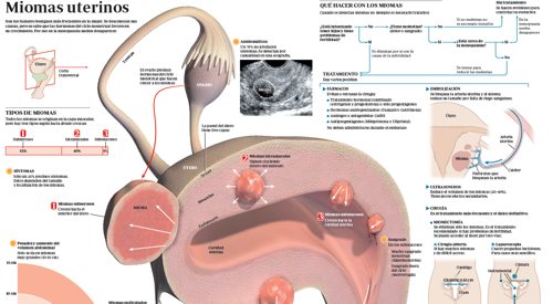Miomas Uterinos Diagnostico Y Tratamiento Clinica Universidad De Navarra