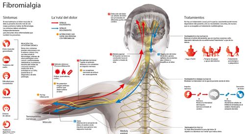 Fibromialgia: Comprender los Síntomas, Diagnóstico y Tratamiento de esta Enfermedad Crónica