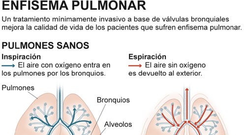 2010_img_preview_enfisema_pulmonar
