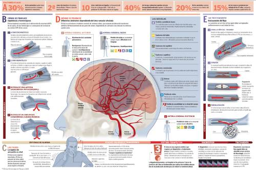 Manejo de la presión arterial en accidente cerebrovascular agudo