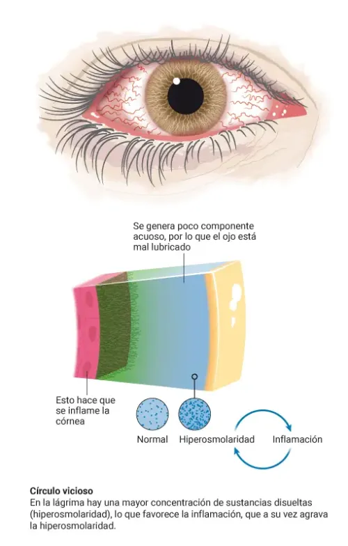 Tipo de ojo seco. Acuodeficiente. Clínica Universidad de Navarra Infografía sobre el tipo de ojo seco acuodeficiente, el que tiene una disminución en la producción de lágrimas acuosas.