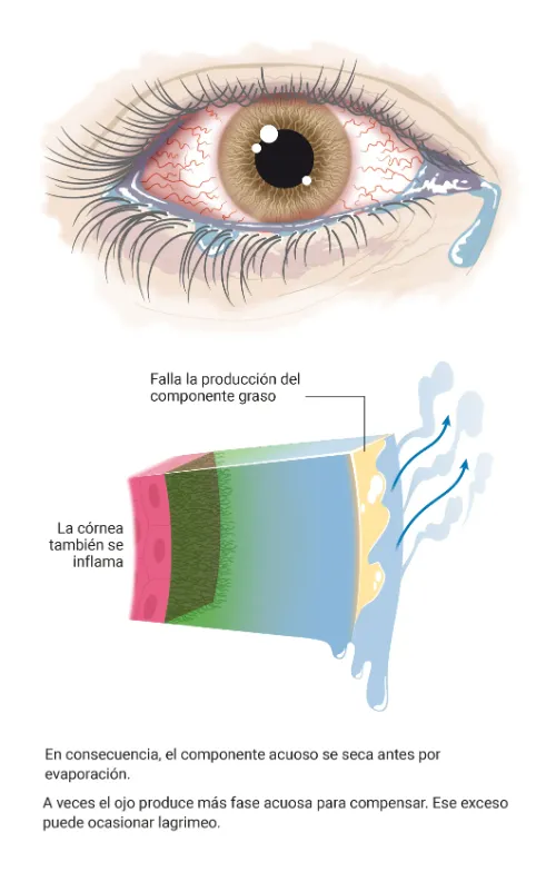 Tipo de ojo seco. Evaporativo. Clínica Universidad de Navarra Infografía sobre el tipo de ojo seco evaporativo, una disminución en la producción de la capa lipídica de las lágrimas o por una mayor evaporación de esta capa.