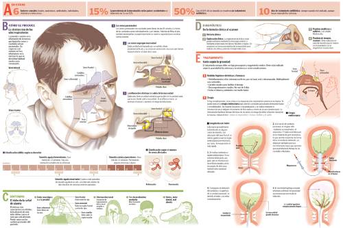 infografico-max-sinusitis
