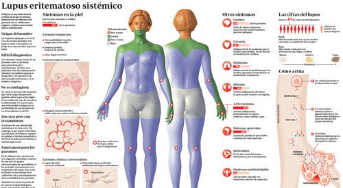 2015-img-lupus <p>Imagen preview del infográfico sobre el lupus</p>