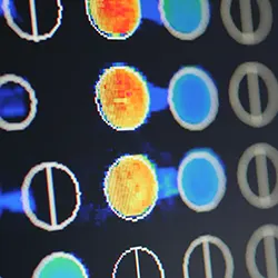 Diagnóstico por microarray. Alergología. Clínica U. Navarra Imagen de la técnica de diagnóstico por microarrays. Alergología. Clínica Universidad de Navarra