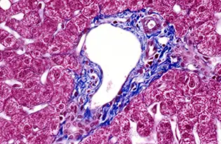 segunda-opinion-ap Imagen de muestra de anatomía patológica. Clínica Universidad de Navarra