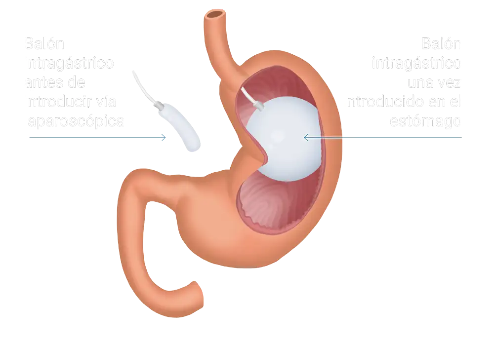 balon-intragastrico-area-obesidad