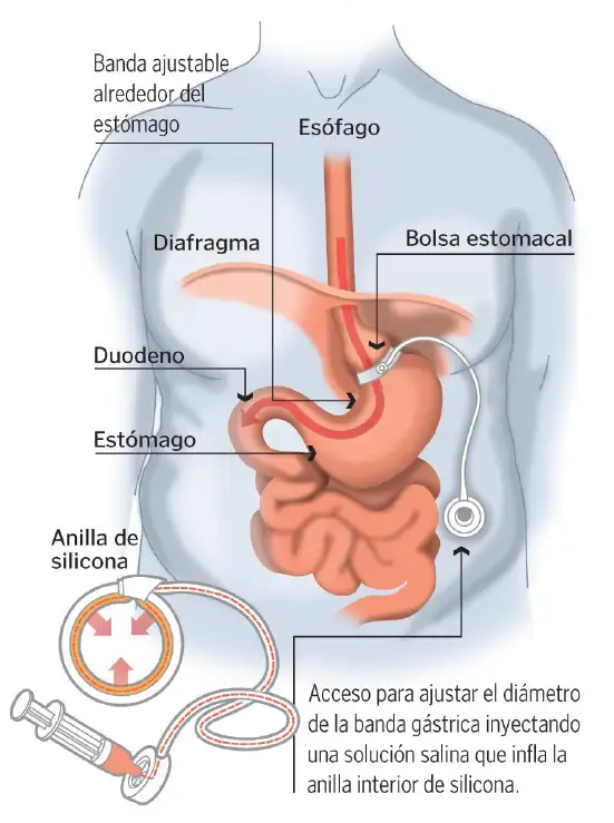 banda-gastrica-ajustable Es una técnica quirúrgica con la que se controla la mayor o menor restricción de alimentos que llegan al estómago.