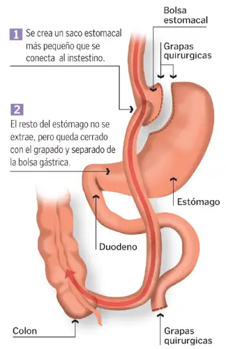 bypass_gastrico <p>Imagen técnica quirúrgica del bypass gástrico </p>