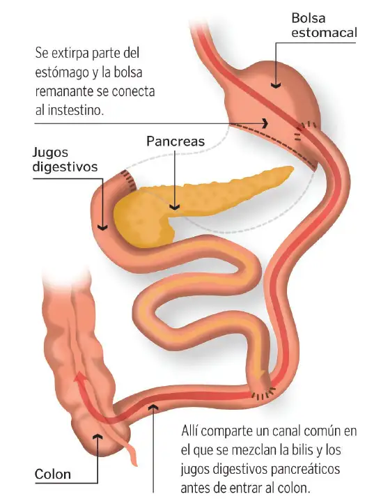 derivacion-biliopancreatica Técnica quirúrgica para reducir el tamaño del estómago y del intestino para la absorción de alimentos.