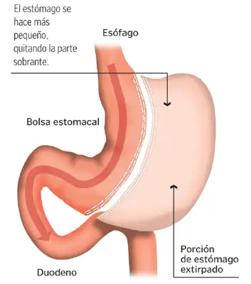 gastrectomia_tubular <p>Imagen de la técnica quirúrgica de la gastrectomía tubular</p>